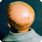 baldness